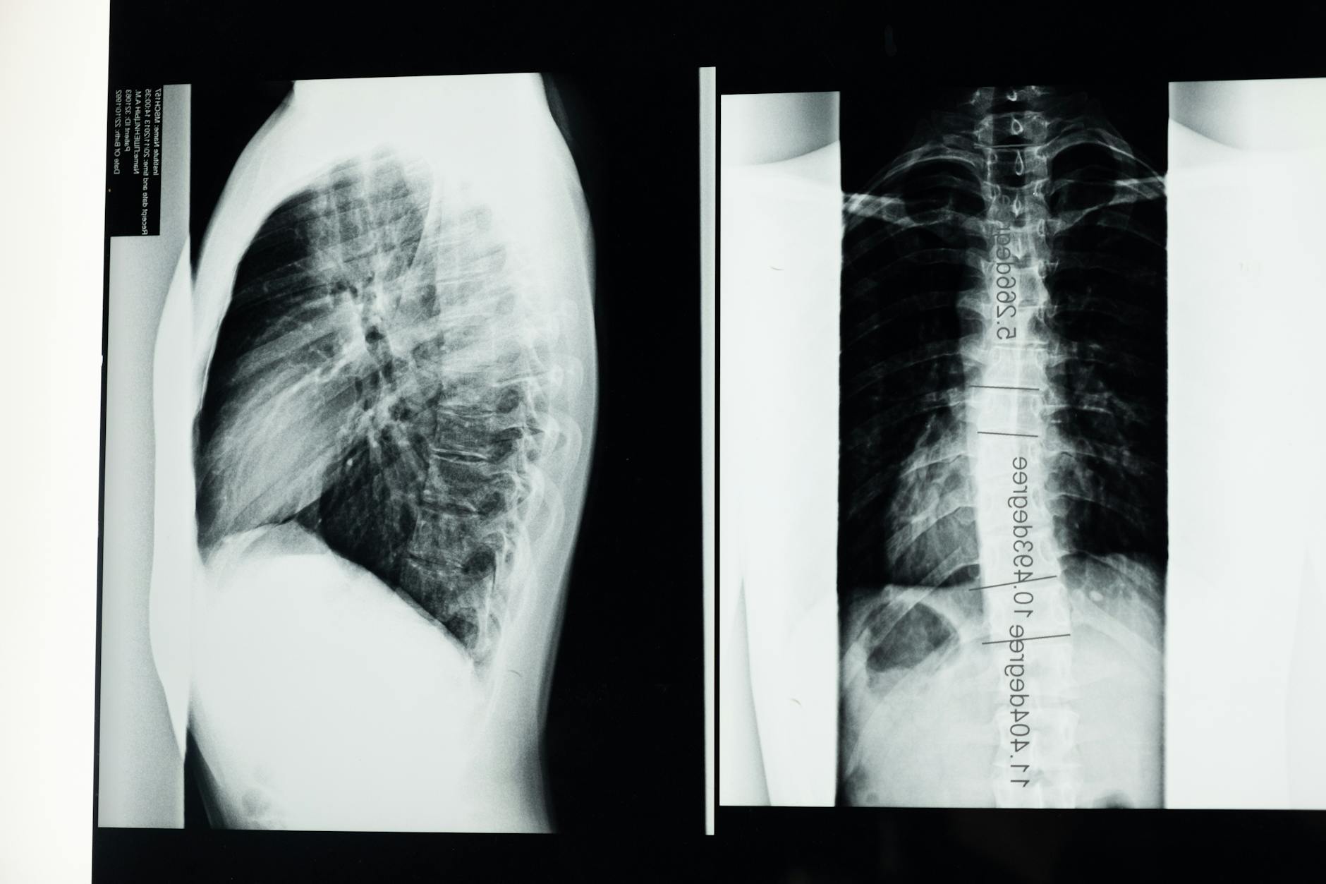 High-resolution X-ray showing a detailed examination of human spine with scoliosis.